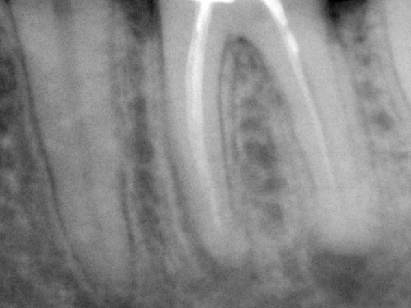 TREATMENT WITH NEW ROOT FILLING AND HEALING OF CHRONIC INFLAMMATION NEAR THE ROOT